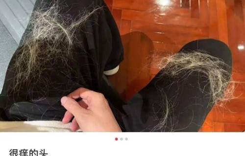 薛之谦晒图自曝“满头斑秃和水泡”！反复漂染发头皮损伤